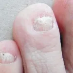 【悲報】爪水虫、罹ったら終わりｗｗｗｗｗｗｗｗｗｗｗｗｗｗｗｗ