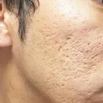 【急募】クレーターになったニキビ跡←これの治し方教えてくれｗｗｗｗｗｗｗｗｗｗｗｗｗｗｗｗ