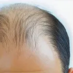 【速報】「ハゲ」、来月から放送禁止用語へ →代替表現は「ナチュラル」で統一・・・・
