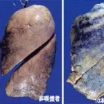 【画像】タバコを吸った肺、真っ黒すぎてやばい。（おまえらの想像以上にやばい）