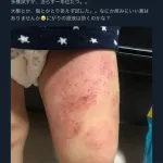 【悲報】自然派ママさん「助けて!息子の足が治らないの😭あらゆることを試したのに…」wwwwwwwwww