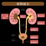 【悲報】尿管結石経験者さん、それよりきつかった痛みを挙げてけｗｗｗｗｗｗｗｗｗｗ