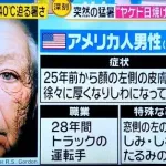 【悲報】男さん、日焼け止めを塗らなかった結果ｗｗｗｗｗｗｗｗｗｗ