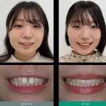 【悲報】日本人さんの歯、ガチで汚すぎるｗｗｗｗｗｗｗｗｗｗ