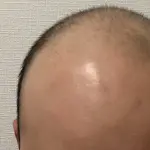 【衝撃】薄毛男性さん、ハゲ治療薬を半年飲み続けて無事復活ｗｗｗｗｗｗｗｗｗｗ