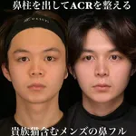 【朗報】女さん、ガチで鼻整形に成功してしまうｗｗｗｗｗｗｗｗｗｗ