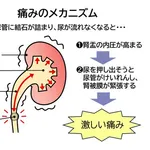 【悲報】お前らさん、尿道結石だけはガチで予防しといた方がいい・・・・・・・・・