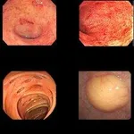 【戦慄】大腸ガンとかいうガチで怖すぎる病気・・・・・・・・・